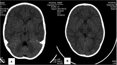 A case report and literature review on tocilizumab-cured acute necrotizing encephalopathy caused by influenza A virus